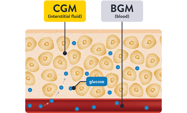 A diagram showing that CGMs measure glucose in interstitial fluid, while BGMs measure it in the blood.
