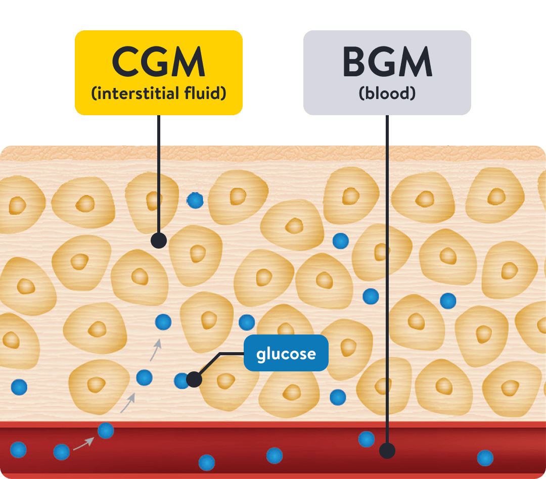 Cross-section diagram of skin tissue showing how a CGM measures glucose in interstitial fluid compared to a BGM that measures glucose in blood.