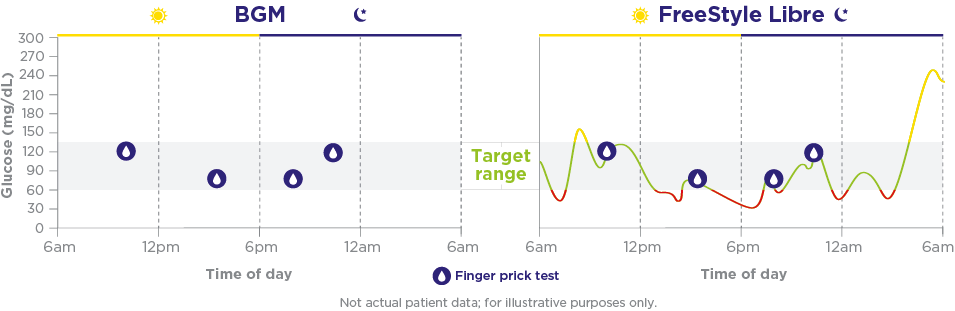 Graphs comparing BGM and CGM's glucose tracking