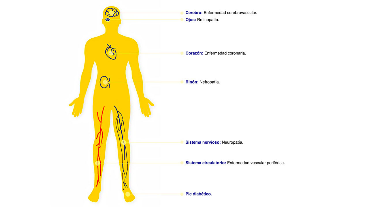 cuerpo humano ilustrando las lesiones causadas debido al exceso de glucosa.