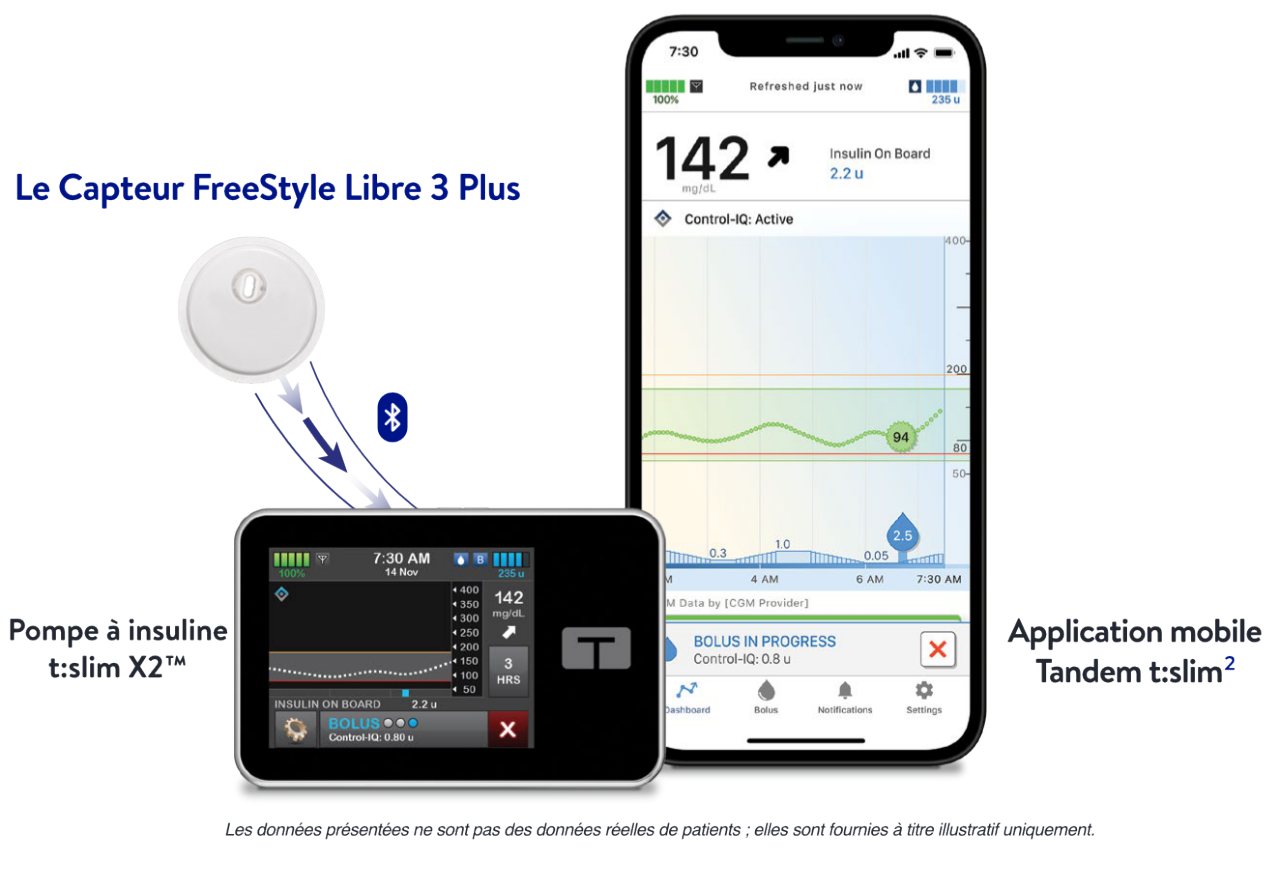 Capteur de glucose en continu FreeStyle Libre 3 Plus et système d’administration automatisée d’insuline Tandem.