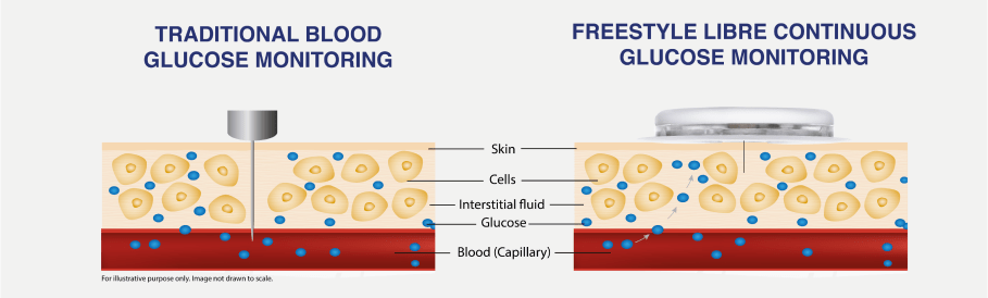 Blood glucose monitoring vs continuous glucose monitoring