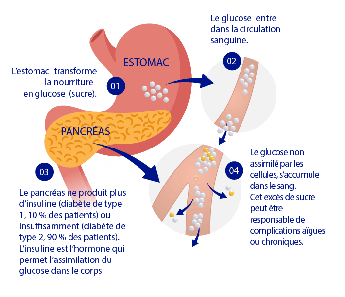 diagramme du diabète de type 1 pancréas