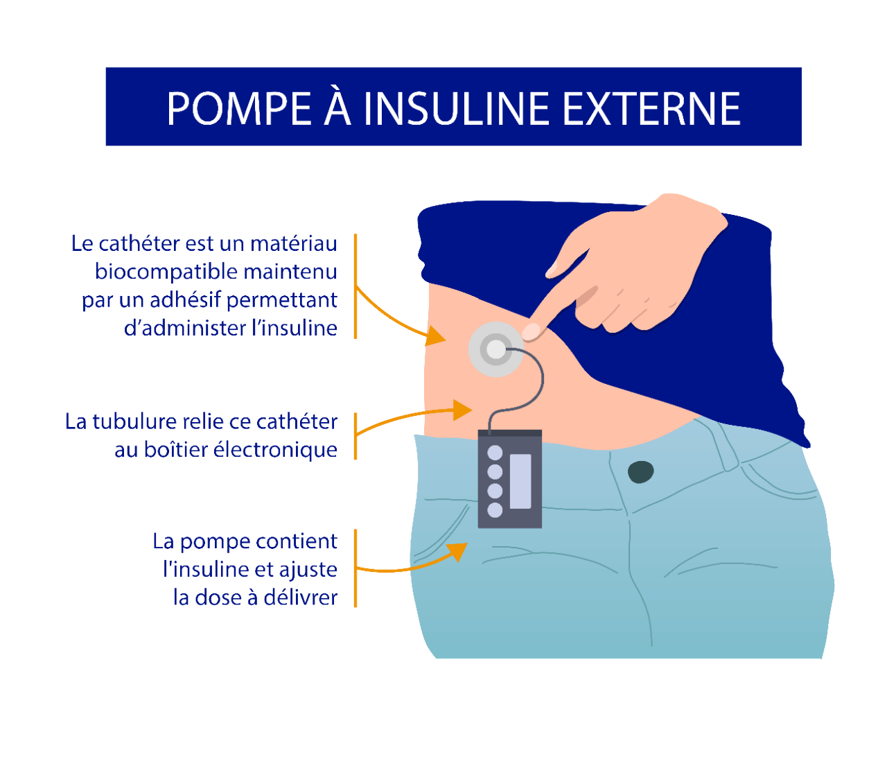 Les pompes à insuline externe