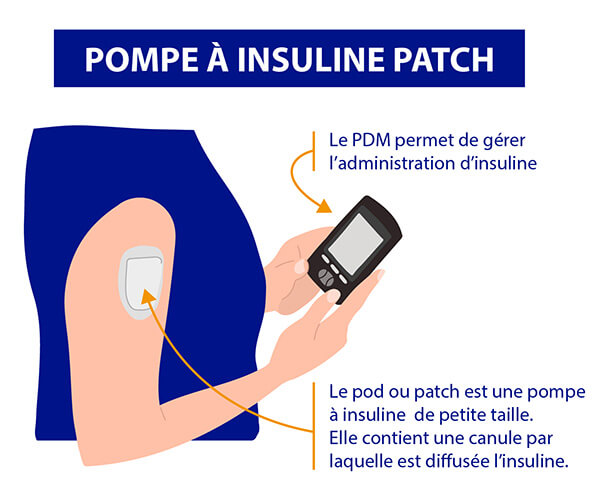 Les pompes à insuline patch