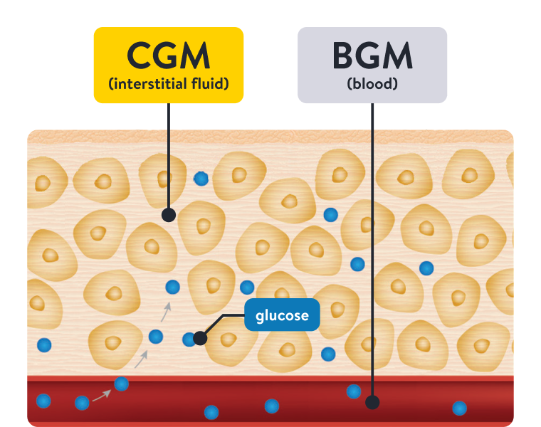 Diagram showing why CGM & BGM readings differ